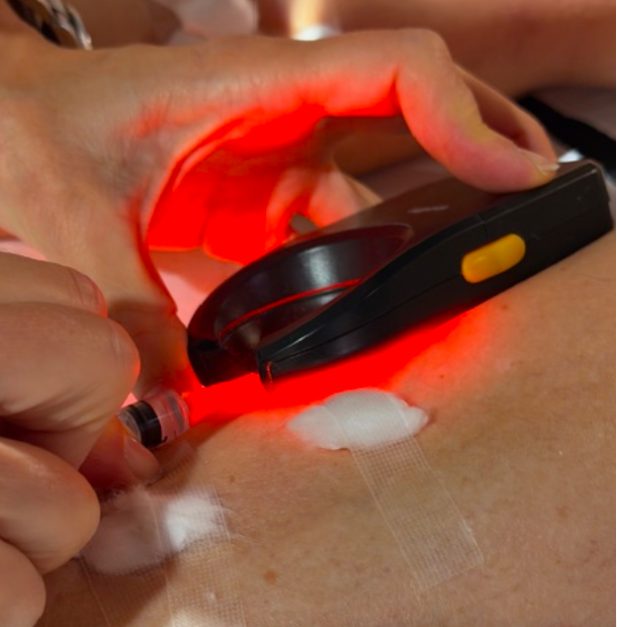 Traitement par laser vasculaire NdYag