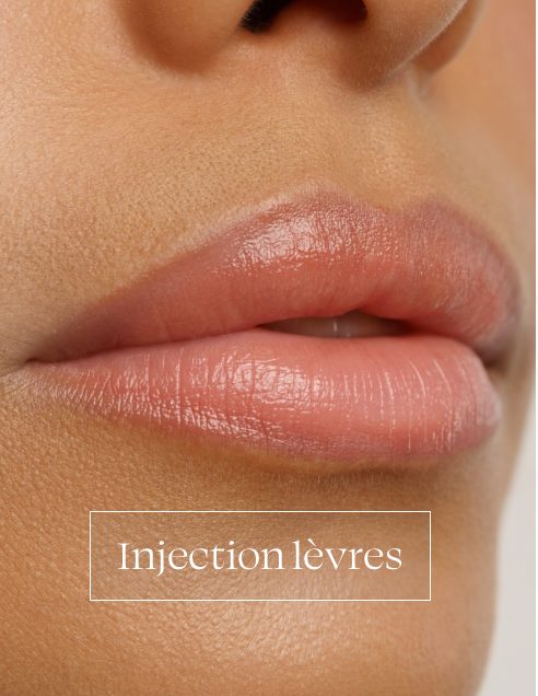 Injection des lèvres
