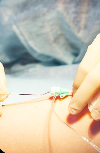 Mise en place d'un cathéter endoveineux sous contrôle échographique