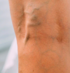 Exemple de varice sur la jambe