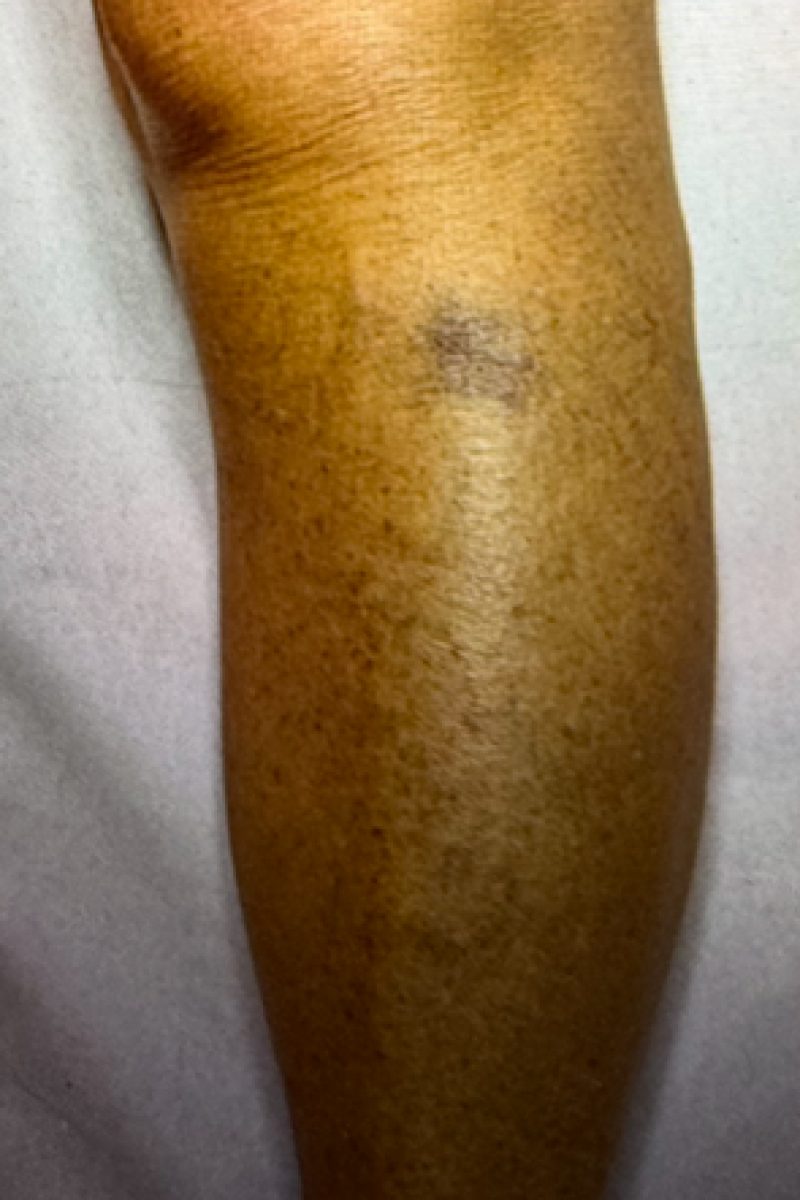 Varicosités des jambes avant traitement